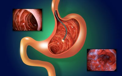 Are Gastric ulcers a problem?